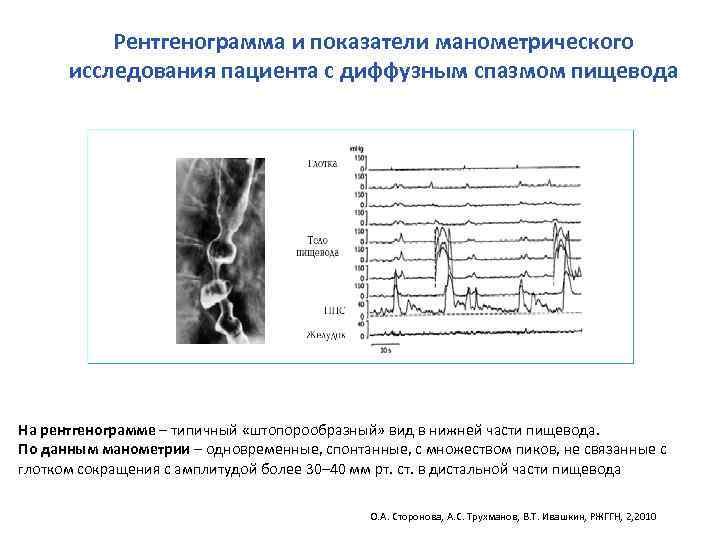 Рентгенограмма и показатели манометрического исследования пациента с диффузным спазмом пищевода На рентгенограмме –