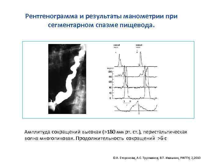 Рентгенограмма и результаты манометрии при сегментарном спазме пищевода. Амплитуда сокращений высокая (>180 мм рт.