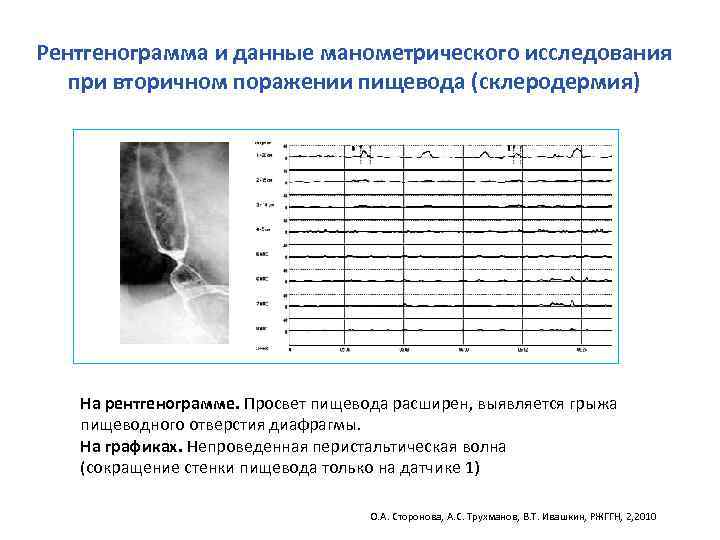 Рентгенограмма и данные манометрического исследования при вторичном поражении пищевода (склеродермия) На рентгенограмме. Просвет пищевода