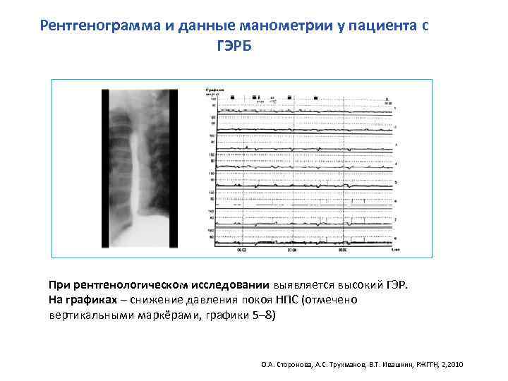 Рентгенограмма и данные манометрии у пациента с ГЭРБ При рентгенологическом исследовании выявляется высокий ГЭР.