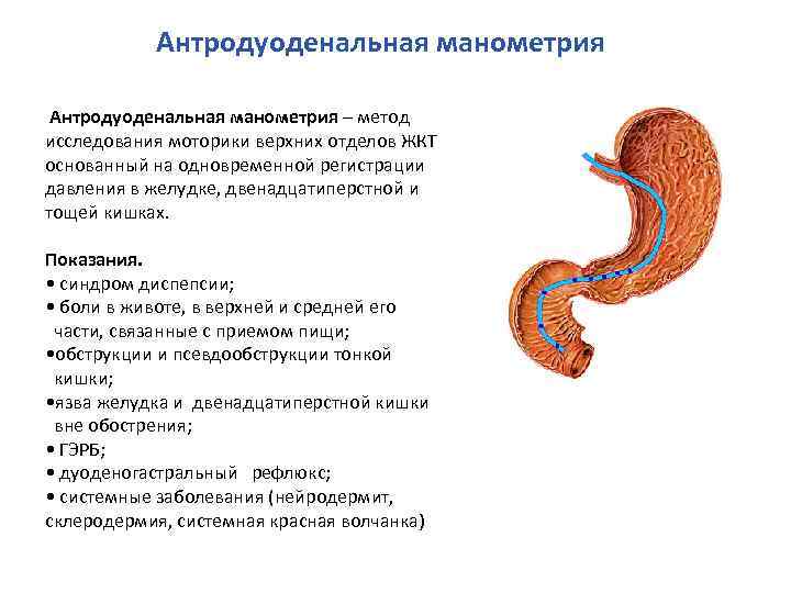 Антродуоденальная манометрия – метод исследования моторики верхних отделов ЖКТ основанный на одновременной регистрации давления