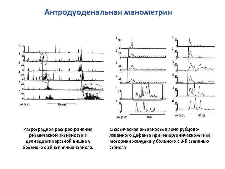 Антродуоденальная манометрия Ретроградное распространение ритмической активности в двенадцатиперстной кишке у больного с 3 й