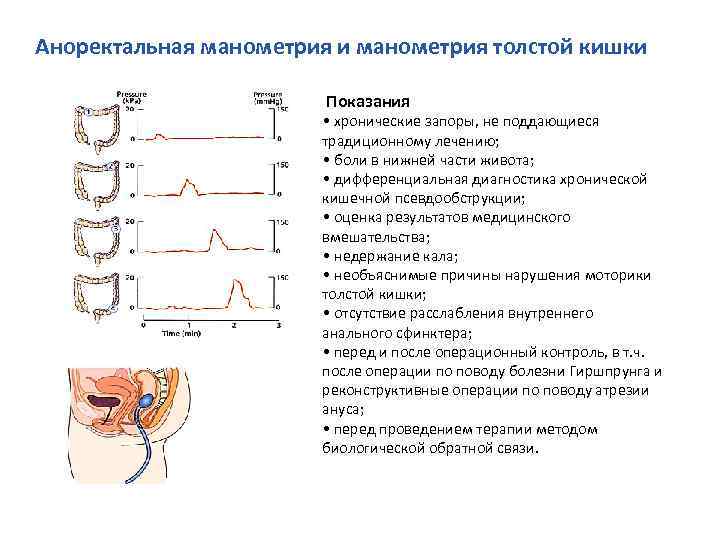 Манометрия сфинктера. Манометрия прямой кишки. Ректальная манометрия. Манометрия кишечника.