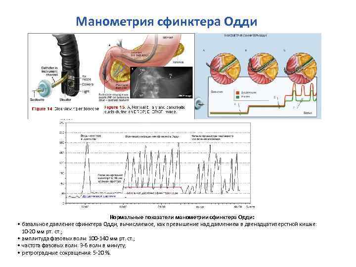 Спазм сфинктера одди. Манометрия сфинктера Одди. Манометрия высокого разрешения пищевода. Стеноз сфинктера Одди рентген. Оперативный доступ к сфинктера Одди.