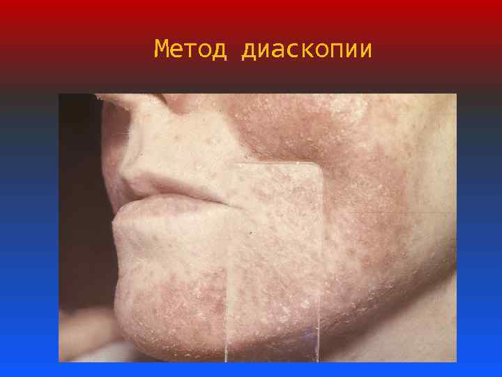 Метод диаскопии 