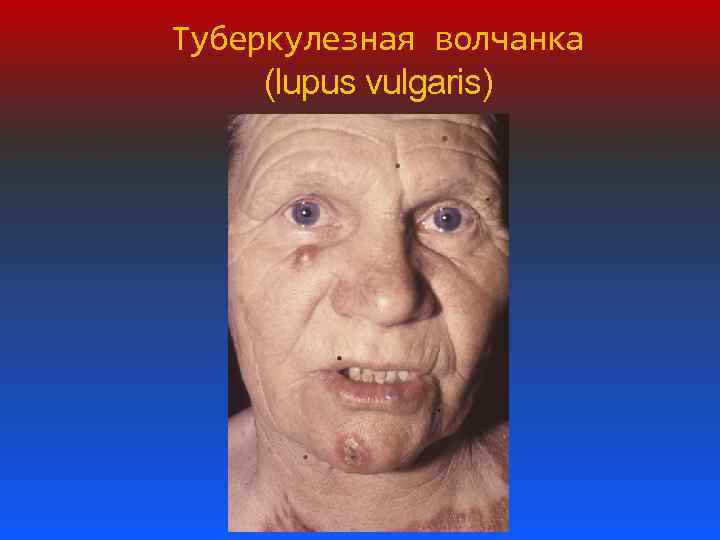 Туберкулезная волчанка (lupus vulgaris) 