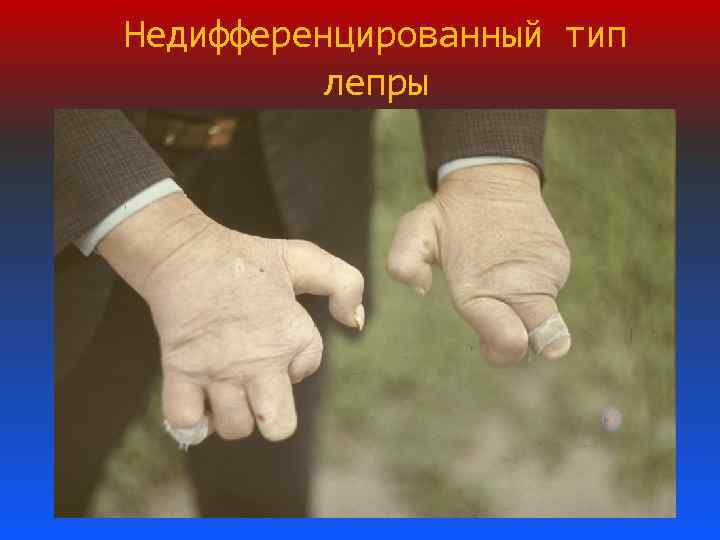 Недифференцированный тип лепры 