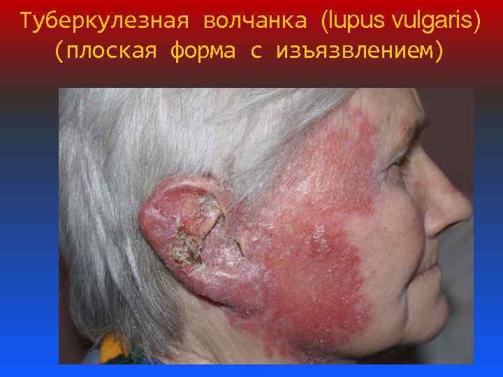 Туберкулезная волчанка (lupus vulgaris) (плоская форма с изъязвлением) 