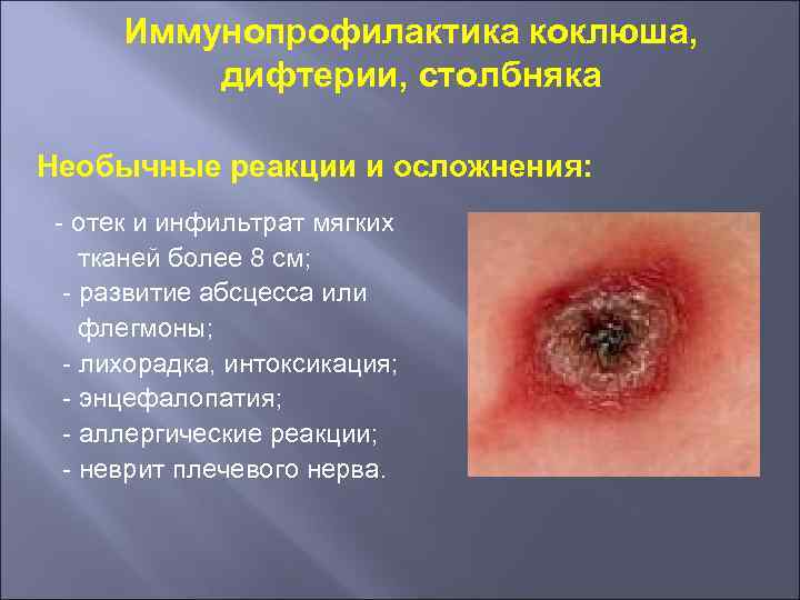 Иммунопрофилактика коклюша, дифтерии, столбняка Необычные реакции и осложнения: - отек и инфильтрат мягких тканей