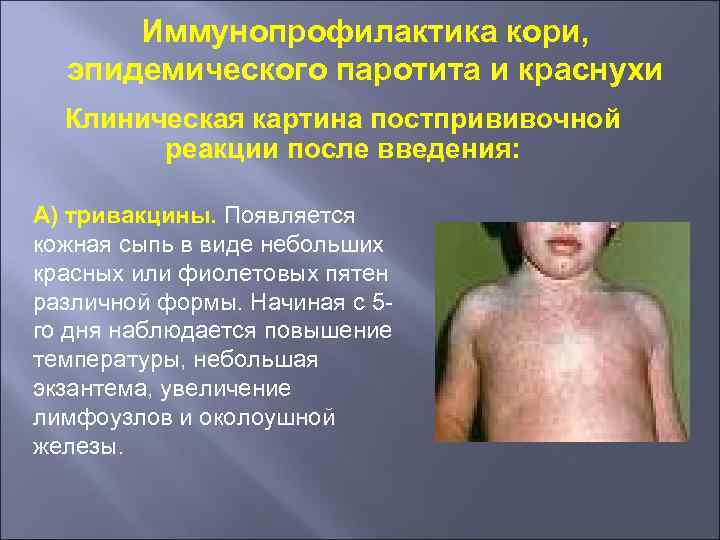 Иммунопрофилактика кори, эпидемического паротита и краснухи Клиническая картина постпрививочной реакции после введения: А) тривакцины.