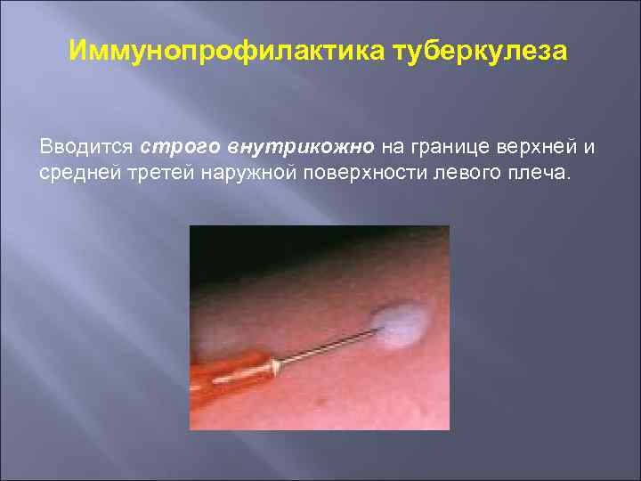 Иммунопрофилактика туберкулеза Вводится строго внутрикожно на границе верхней и средней третей наружной поверхности левого