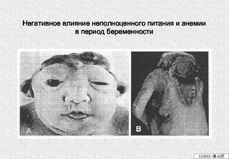 Негативное влияние неполноценного питания и анемии в период беременности 11/2002 –第 42页 