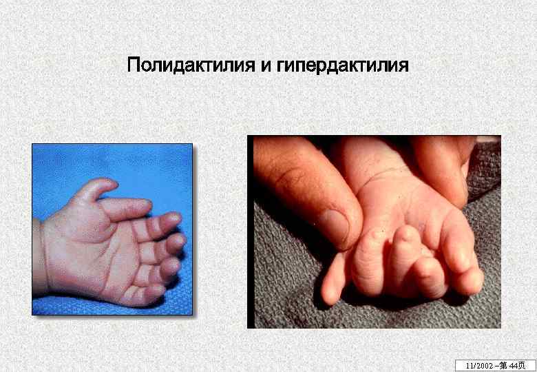 Полидактилия и гипердактилия 11/2002 –第 44页 