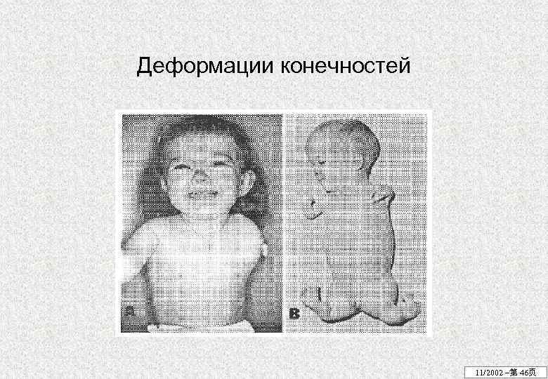 Деформации конечностей 11/2002 –第 46页 