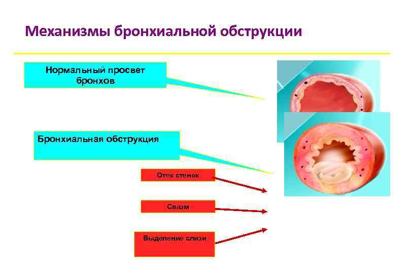 Механизмы бронхиальной обструкции Нормальный просвет бронхов Бронхиальная обструкция Отек стенок Спазм Выделение слизи 