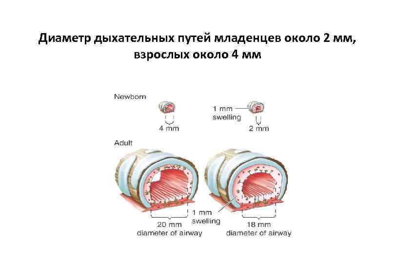 Диаметр дыхательных путей младенцев около 2 мм, взрослых около 4 мм 