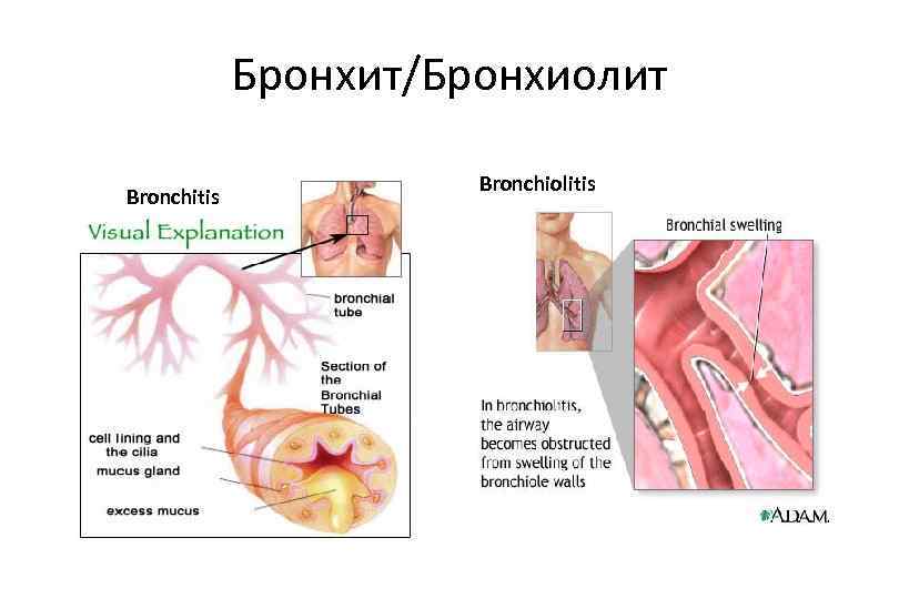 Бронхит/Бронхиолит Bronchitis Bronchiolitis 