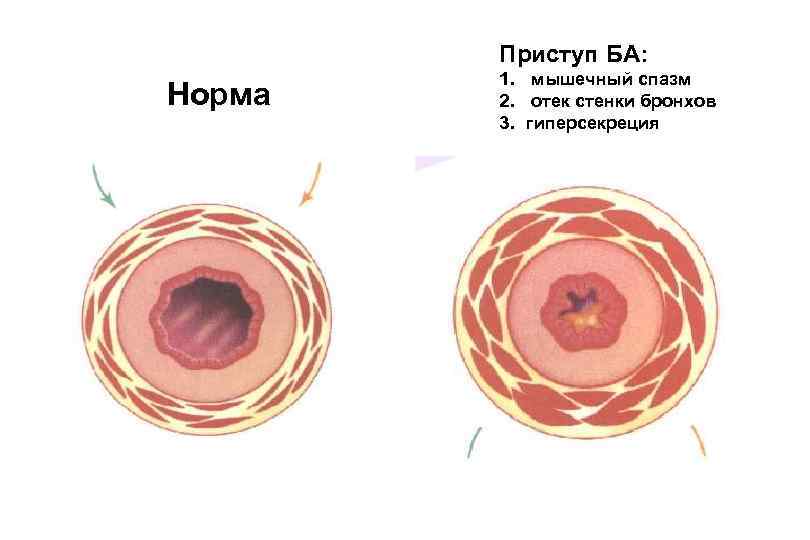 Изменения стенок бронхов