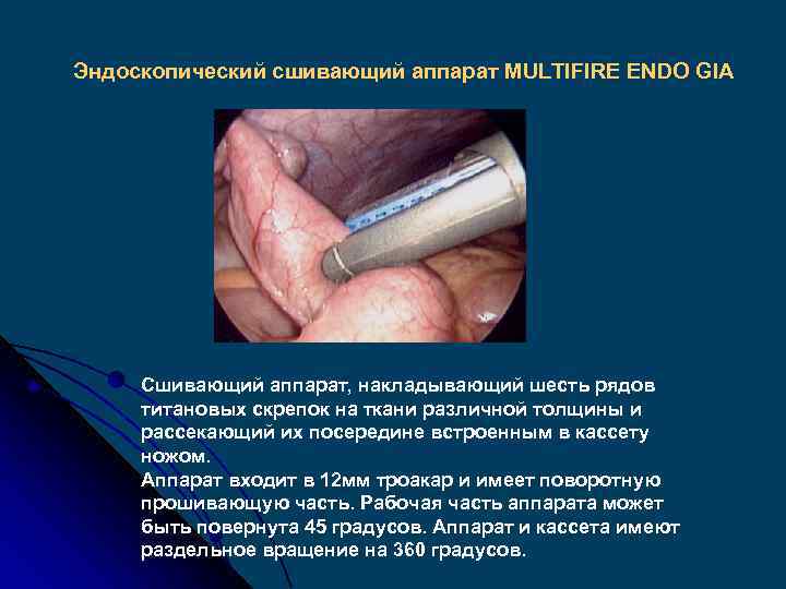 Эндоскопический сшивающий аппарат MULTIFIRE ENDO GIA Сшивающий аппарат, накладывающий шесть рядов титановых скрепок на