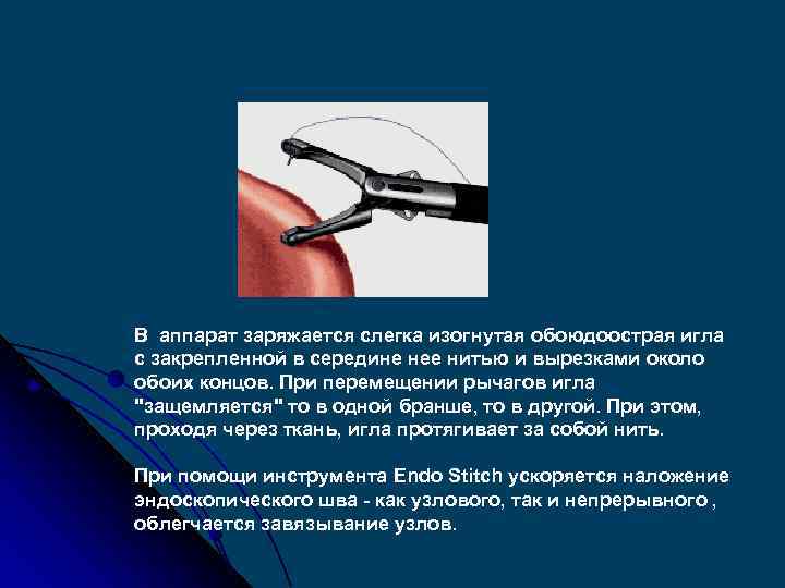 В аппарат заряжается слегка изогнутая обоюдоострая игла с закрепленной в середине нее нитью и