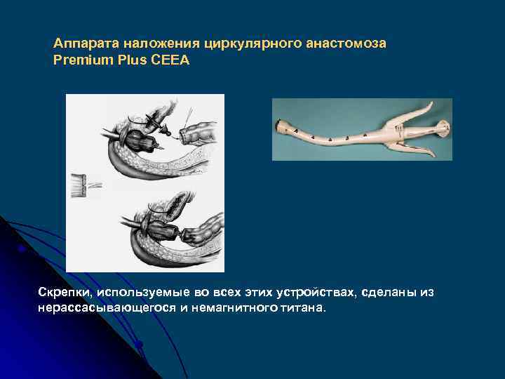 Аппарата наложения циркулярного анастомоза Premium Plus СЕЕА Скрепки, используемые во всех этих устройствах, сделаны