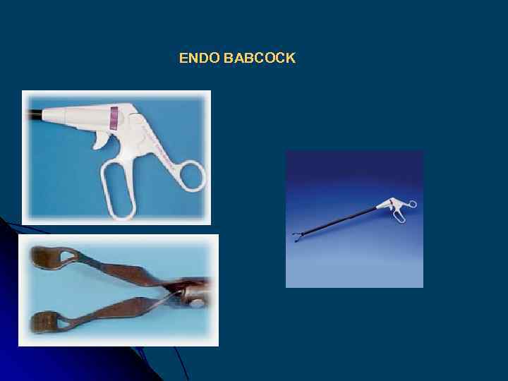 ENDO BABCOCK 