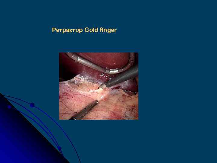 Ретрактор Gold finger 