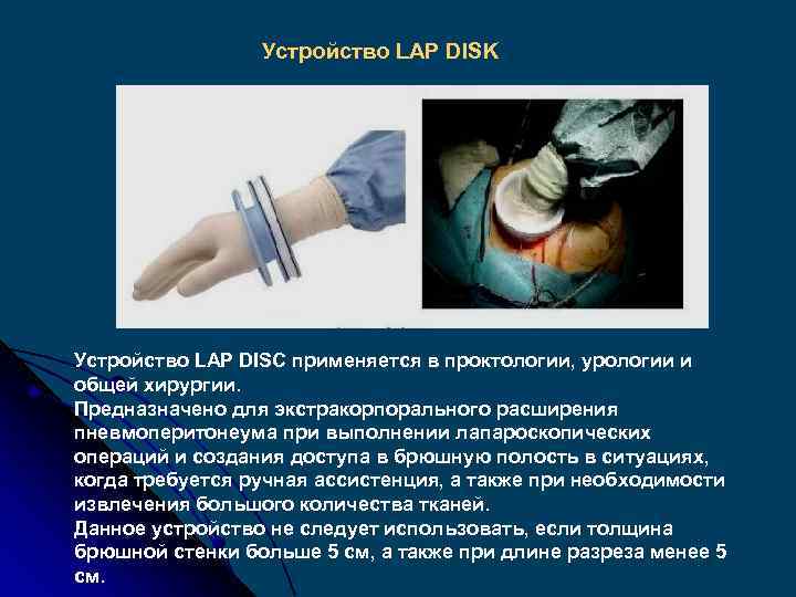 Устройство LAP DISK Устройство LAP DISC применяется в проктологии, урологии и общей хирургии. Предназначено