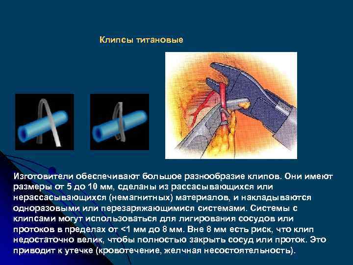 Клипсы титановые Изготовители обеспечивают большое разнообразие клипов. Они имеют размеры от 5 до 10