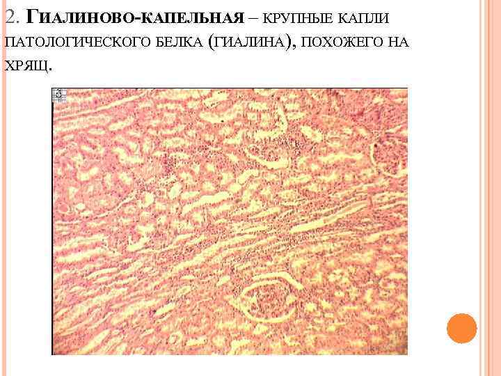 2. ГИАЛИНОВО-КАПЕЛЬНАЯ – КРУПНЫЕ КАПЛИ ПАТОЛОГИЧЕСКОГО БЕЛКА (ГИАЛИНА), ПОХОЖЕГО НА ХРЯЩ. 