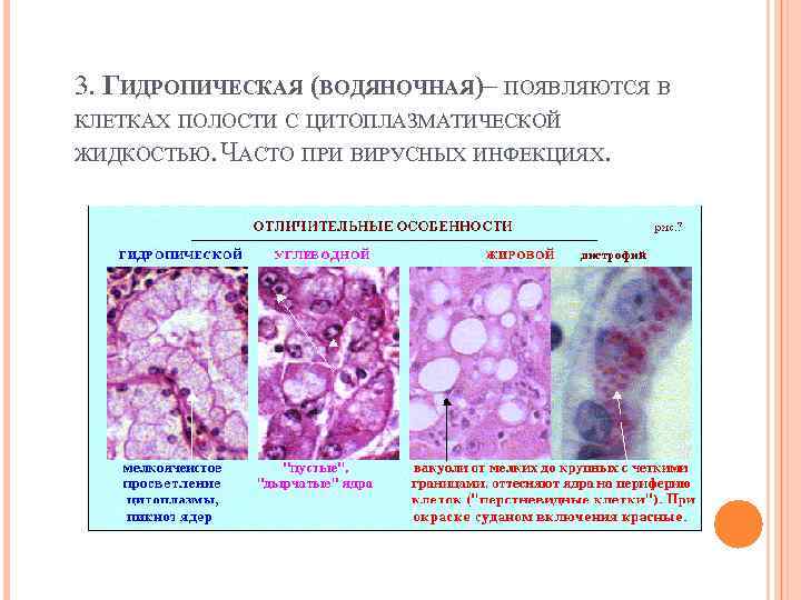 3. ГИДРОПИЧЕСКАЯ (ВОДЯНОЧНАЯ) ПОЯВЛЯЮТСЯ В – КЛЕТКАХ ПОЛОСТИ С ЦИТОПЛАЗМАТИЧЕСКОЙ ЖИДКОСТЬЮ. ЧАСТО ПРИ ВИРУСНЫХ