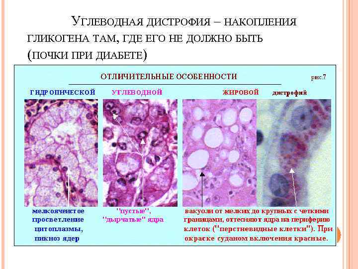  УГЛЕВОДНАЯ ДИСТРОФИЯ – НАКОПЛЕНИЯ ГЛИКОГЕНА ТАМ, ГДЕ ЕГО НЕ ДОЛЖНО БЫТЬ (ПОЧКИ ПРИ