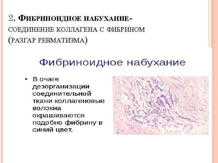 Фибриноидное набухание это. Фибриноидное набухание патанатомия. Фибриноидное набухание микроскопия. Фибриноидное набухание это в патологии. Фибриноидное набухание Электронограмма.