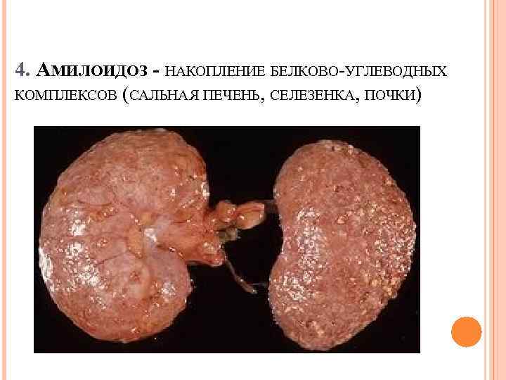 4. АМИЛОИДОЗ - АКОПЛЕНИЕ БЕЛКОВО-УГЛЕВОДНЫХ Н КОМПЛЕКСОВ (САЛЬНАЯ ПЕЧЕНЬ, СЕЛЕЗЕНКА, ПОЧКИ) 