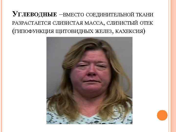 УГЛЕВОДНЫЕ –ВМЕСТО СОЕДИНИТЕЛЬНОЙ ТКАНИ РАЗРАСТАЕТСЯ СЛИЗИСТАЯ МАССА, СЛИЗИСТЫЙ ОТЕК (ГИПОФУНКЦИЯ ЩИТОВИДНЫХ ЖЕЛЕЗ, КАХЕКСИЯ) 
