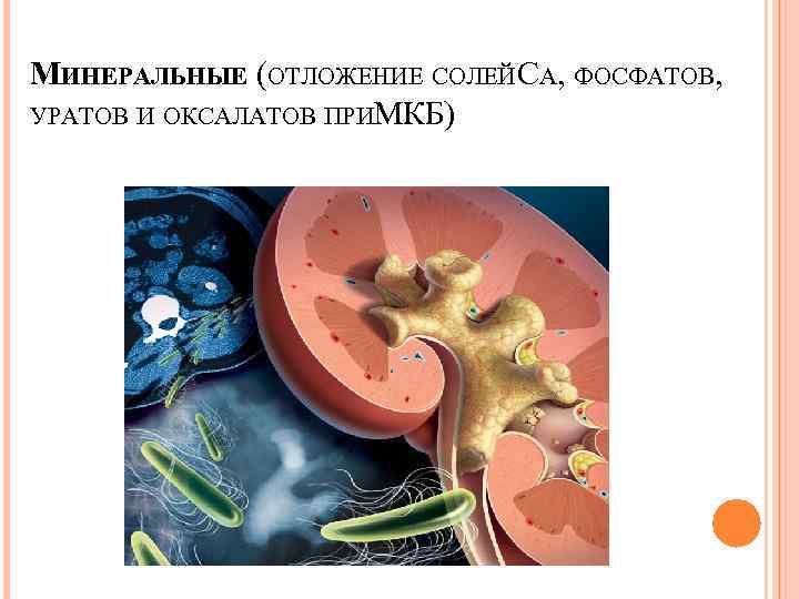 МИНЕРАЛЬНЫЕ (ОТЛОЖЕНИЕ СОЛЕЙ СА, ФОСФАТОВ, УРАТОВ И ОКСАЛАТОВ ПРИМКБ) 