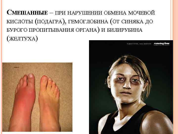 СМЕШАННЫЕ – ПРИ НАРУШЕНИИ ОБМЕНА МОЧЕВОЙ КИСЛОТЫ (ПОДАГРА), ГЕМОГЛОБИНА (ОТ СИНЯКА ДО БУРОГО ПРОПИТЫВАНИЯ