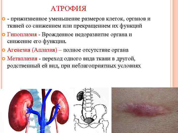  АТРОФИЯ - прижизненное уменьшение размеров клеток, органов и тканей со снижением или прекращением