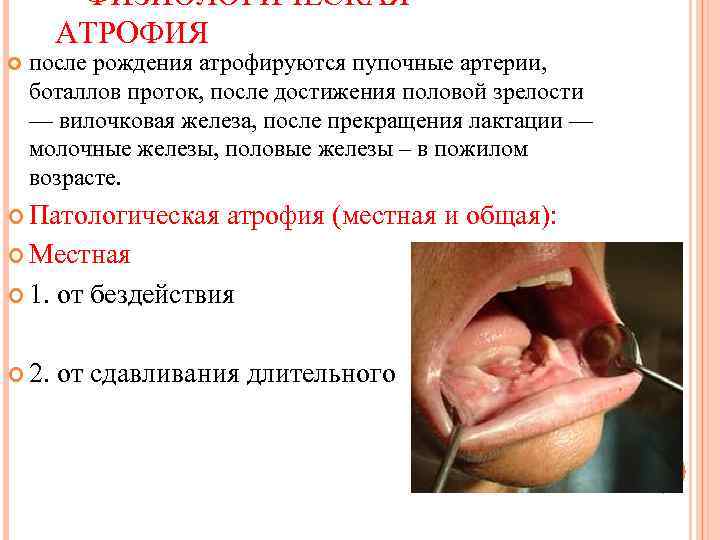  ФИЗИОЛОГИЧЕСКАЯ АТРОФИЯ после рождения атрофируются пупочные артерии, боталлов проток, после достижения половой зрелости
