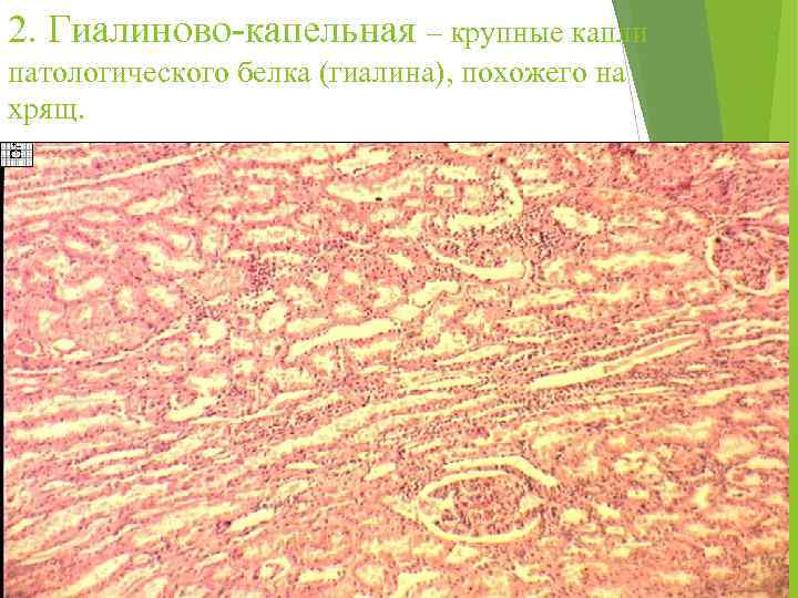 2. Гиалиново-капельная – крупные капли патологического белка (гиалина), похожего на хрящ. 