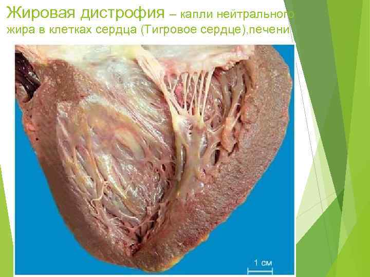 Жировая дистрофия – капли нейтрального жира в клетках сердца (Тигровое сердце), печени 