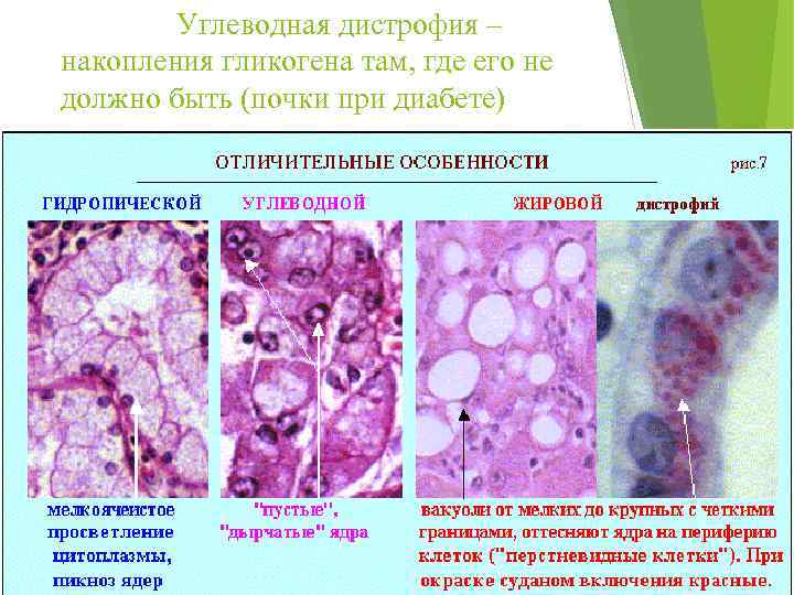  Углеводная дистрофия – накопления гликогена там, где его не должно быть (почки при