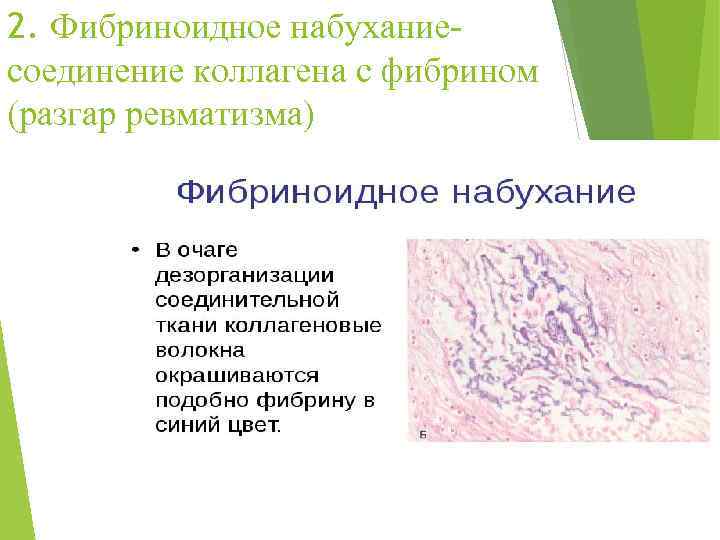 2. Фибриноидное набухание- соединение коллагена с фибрином (разгар ревматизма) 
