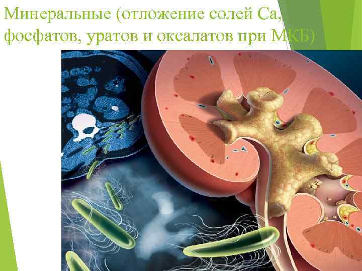 Минеральные (отложение солей Са, фосфатов, уратов и оксалатов при МКБ) 