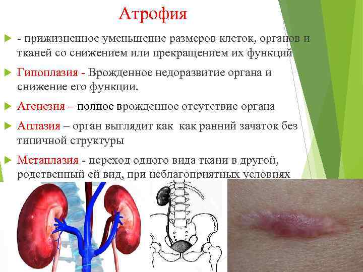  Атрофия - прижизненное уменьшение размеров клеток, органов и тканей со снижением или прекращением