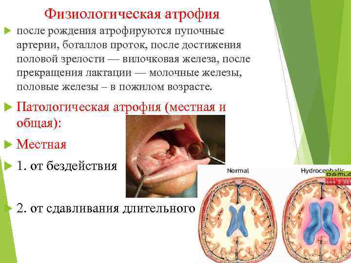  Физиологическая атрофия после рождения атрофируются пупочные артерии, боталлов проток, после достижения половой зрелости