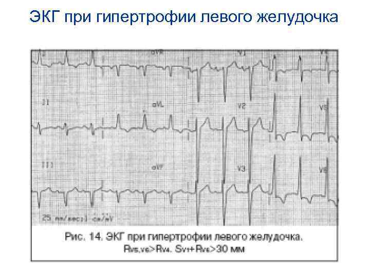 ЭКГ при гипертрофии левого желудочка 