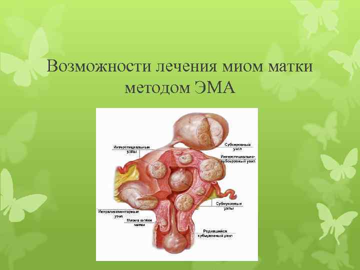 Возможности лечения миом матки методом ЭМА 