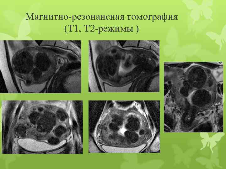 Магнитно-резонансная томография (Т 1, Т 2 -режимы ) 