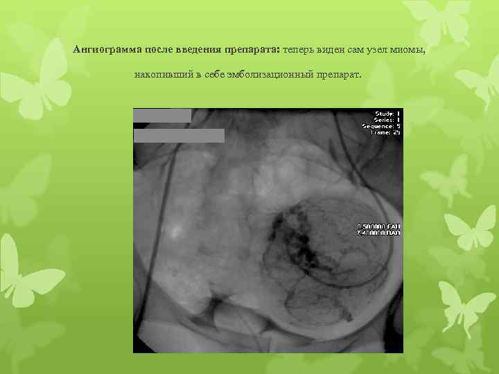 Ангиограмма после введения препарата: теперь виден сам узел миомы, накопивший в себе эмболизационный препарат.
